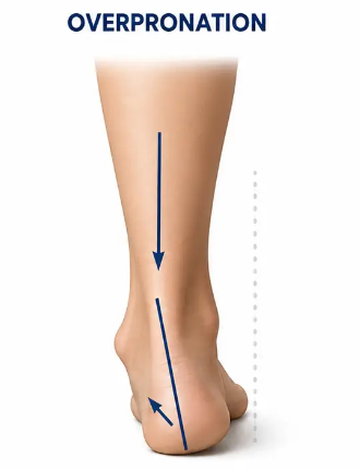 Rolls Inward / Overpronation